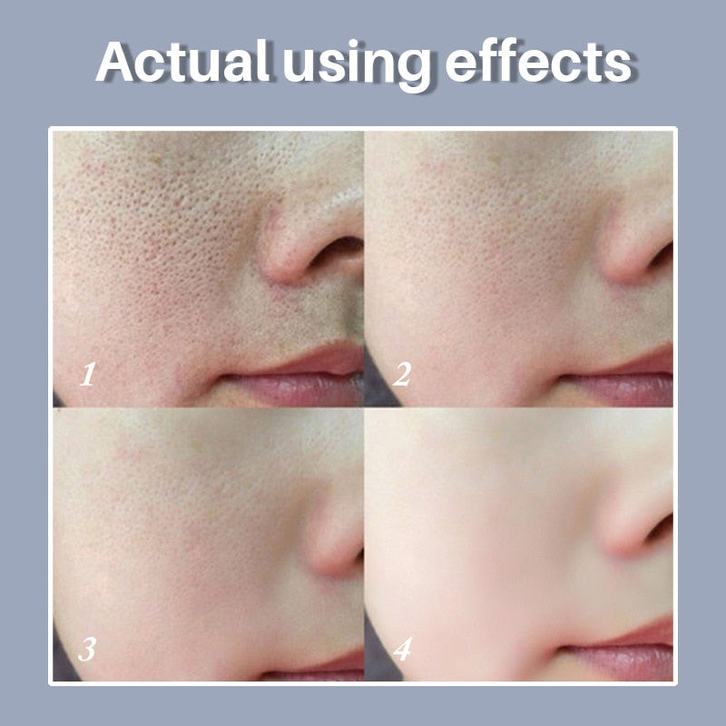 Serum Essence Pores Treatment