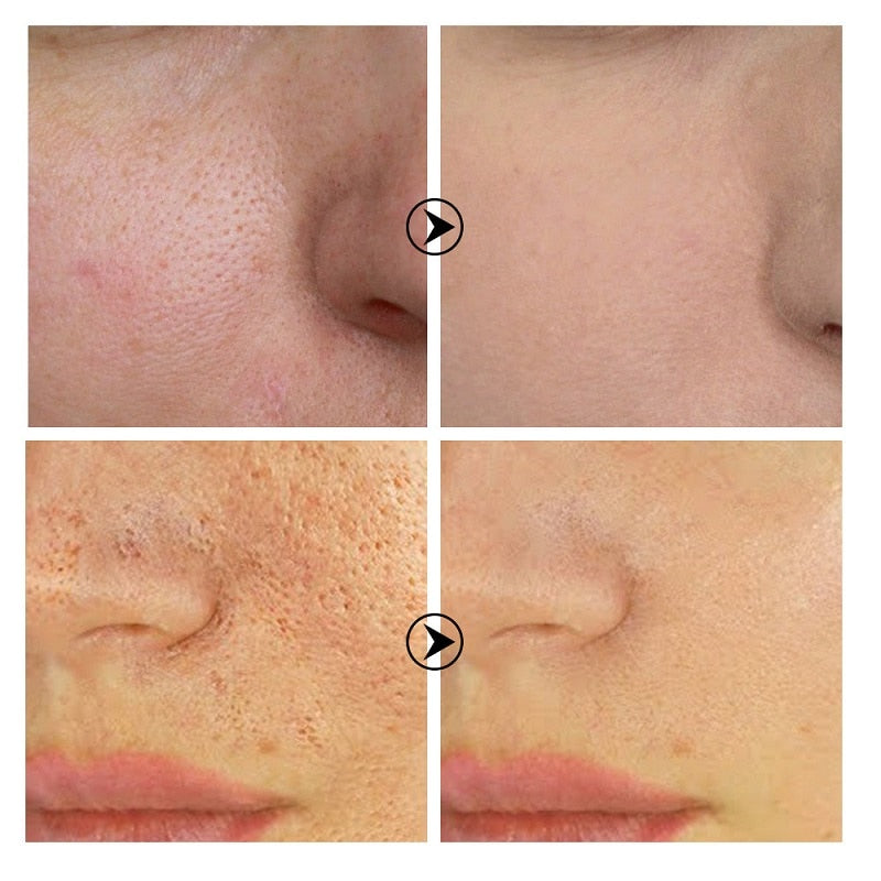 Serum Essence Pores Treatment